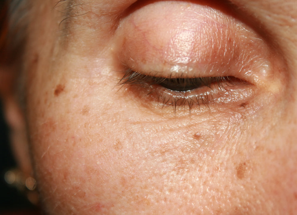 How to Combat Post-Summer Skin Damage | Blog | Rovectin